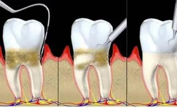 牙周炎跟腎虛有關系嗎？牙周炎跟上火有關系嗎？