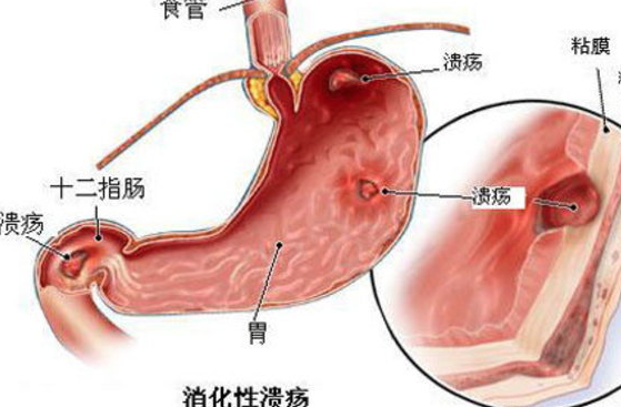 胃潰瘍可以吃羊肉嗎 胃潰瘍飲食注意什么