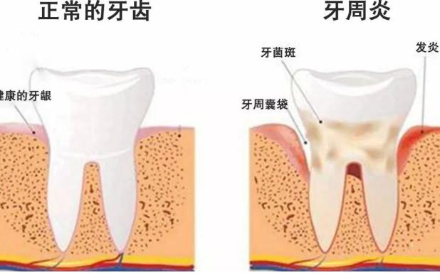 牙周炎檢查？牙周炎小偏方？