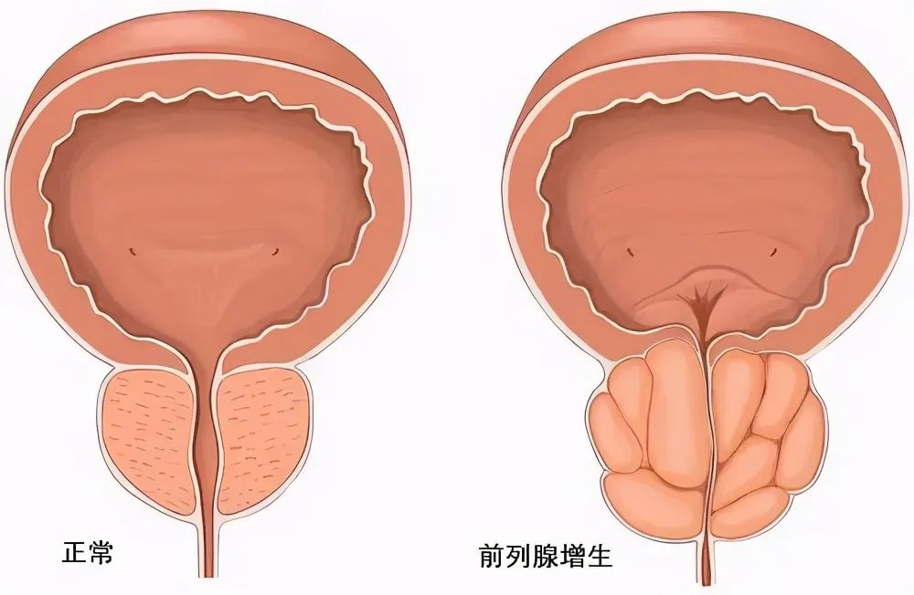 103度水蒸氣“熱死”前列腺病灶Rezūm瑞夢輕松解決中老年男性前列腺增生問題