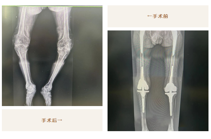 太厲害了！我院骨科助力26年不能站立的他，重新行走！