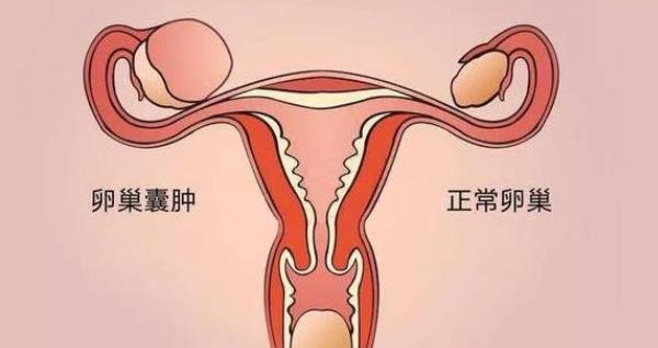 卵巢囊腫大小多少算正常 如何預防卵巢囊腫