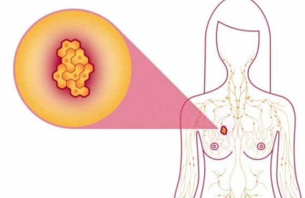 多大年齡容易乳腺增生 乳腺增生結節(jié)怎么回事