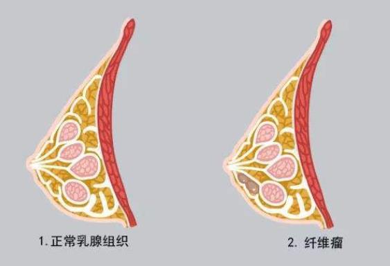 乳腺纖維瘤是微創(chuàng)治療嗎 乳腺纖維瘤微創(chuàng)手術(shù)費(fèi)用是多少