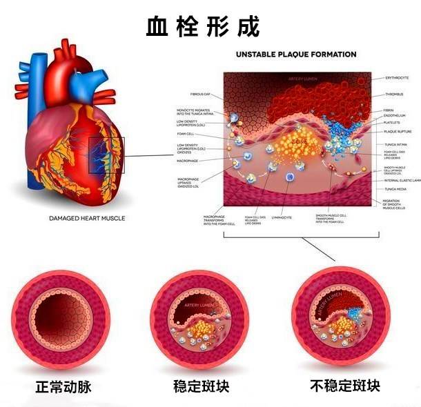 腦梗、頭暈、眼黑總是反復？血脈通栓化斑方就能調理！