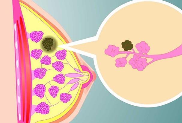乳腺結(jié)節(jié)伴有疼痛是惡變嗎 乳腺增生所致應(yīng)及時就醫(yī)