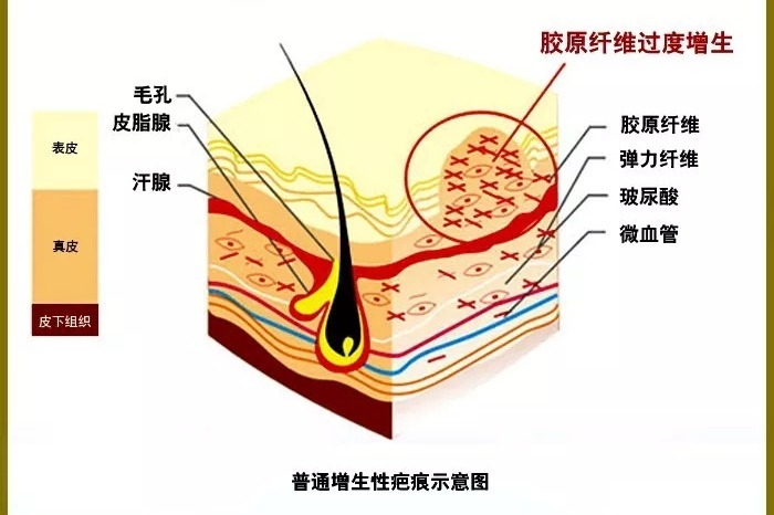 【沈陽膚康疤痕科普】之紋身疤痕，紋身雖美，疤痕防治不可忽視