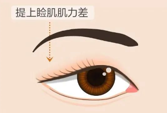 合肥愛爾專家科普：上瞼下垂＝眼皮松弛？其實(shí)真相是……