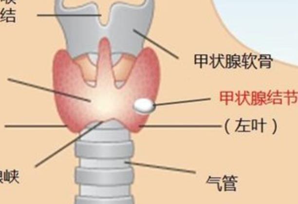 身體多處結節(jié)是不是容易得癌癥 結節(jié)癌變的幾率多大