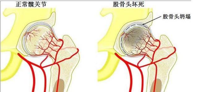 慎用激素藥！激素導(dǎo)致股骨頭壞死不要怕，通血生骨方純中藥調(diào)理，從根源治療！