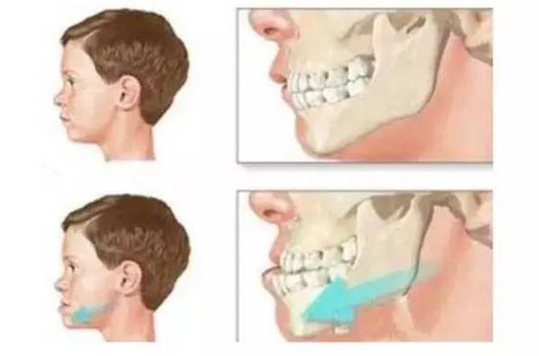地包天矯正要多久 3歲地包天能自己長(zhǎng)好嗎