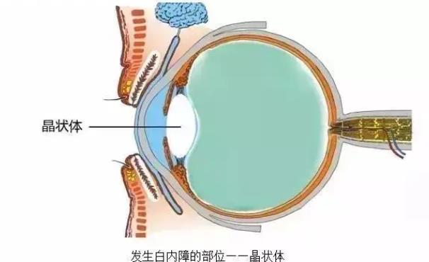 白內(nèi)障術(shù)后多久恢復(fù) 白內(nèi)障手術(shù)后多久可以運(yùn)動(dòng)