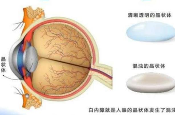 白內(nèi)障有哪些并發(fā)癥 視力色覺改變青光眼失明