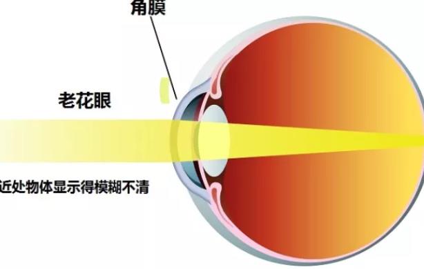 白內障只能做超聲乳化手術嗎 白內障超聲乳化手術多久恢復