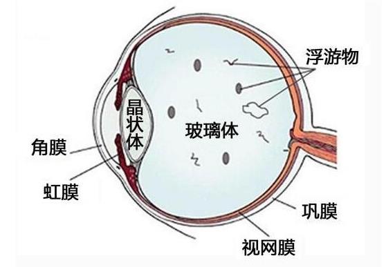 飛蚊癥有哪些表現 有飄動小黑影視物模糊視力下降眼痛