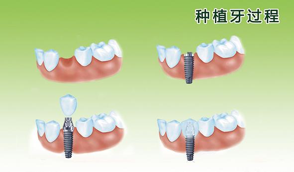 種植牙多久能恢復(fù) 種植牙要疼多久