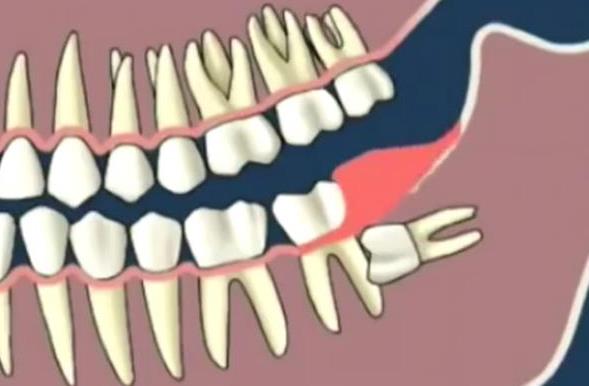 怎么判斷智齒有沒有長歪 智齒疼怎么辦