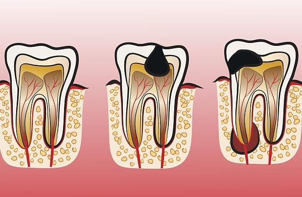 為什么會急性牙髓炎 急性牙髓炎怎么消炎