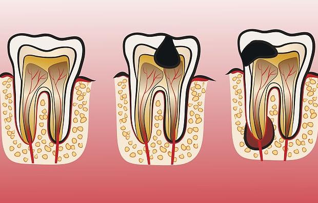 牙髓炎一陣一陣疼怎么回事 急性牙髓炎有哪些癥狀