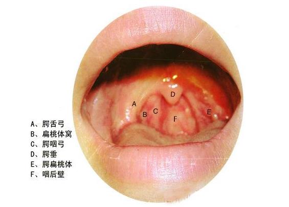 小飛蓬能治好咽炎嗎 鐵笛片對慢性咽炎有效嗎