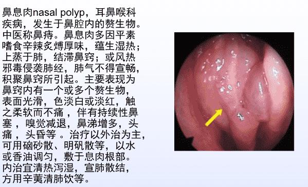 鼻息肉做手術(shù)要住院嗎 鼻息肉做手術(shù)要住院多久