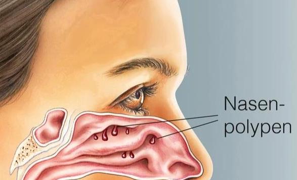 鼻息肉會痛嗎 鼻息肉手術會痛嗎