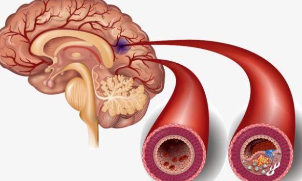 腦梗塞怎么治療 腦梗塞注意什么