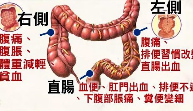 直腸癌早期有哪些癥狀 直腸癌怎么回事