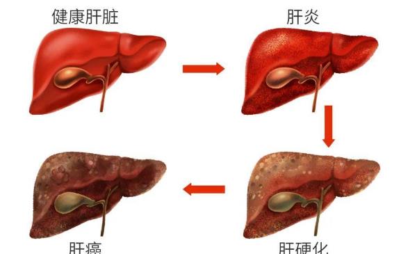 肝硬化患者要做胃鏡嗎 如何預(yù)防和逆轉(zhuǎn)肝硬化