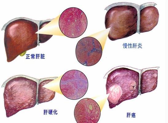 早期肝硬化活多久 肝硬化早期有哪些癥狀