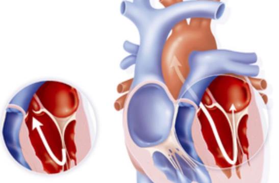 心臟瓣膜病怎么治療 心臟瓣膜病如何護(hù)理