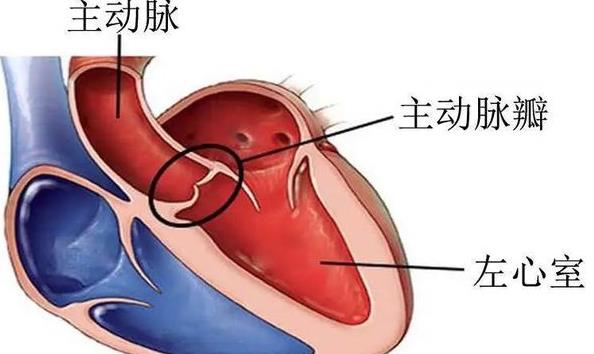 做心臟瓣膜術(shù)后嗓子疼怎么辦 加強生活管理服用藥物