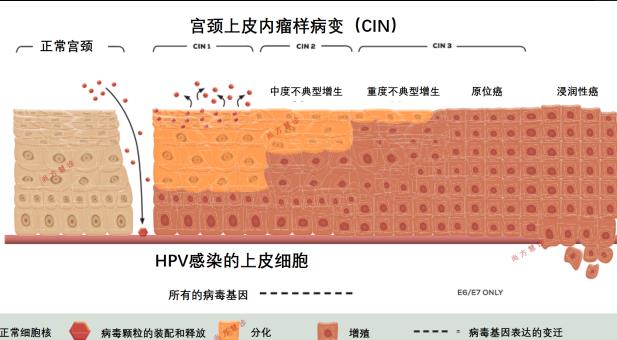 宮頸癌是否可以治愈 hpv51型陽(yáng)性怎么辦