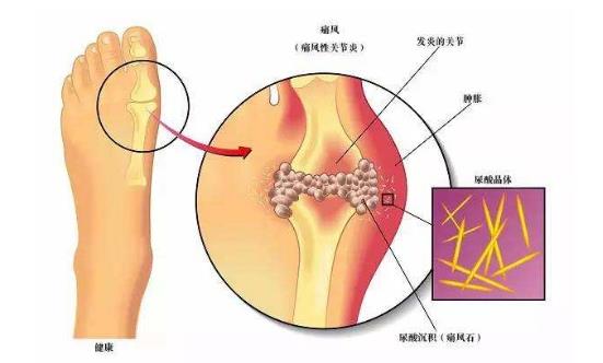 甲亢會引起尿酸高嗎 痛風(fēng)病人可用白蛋白嗎