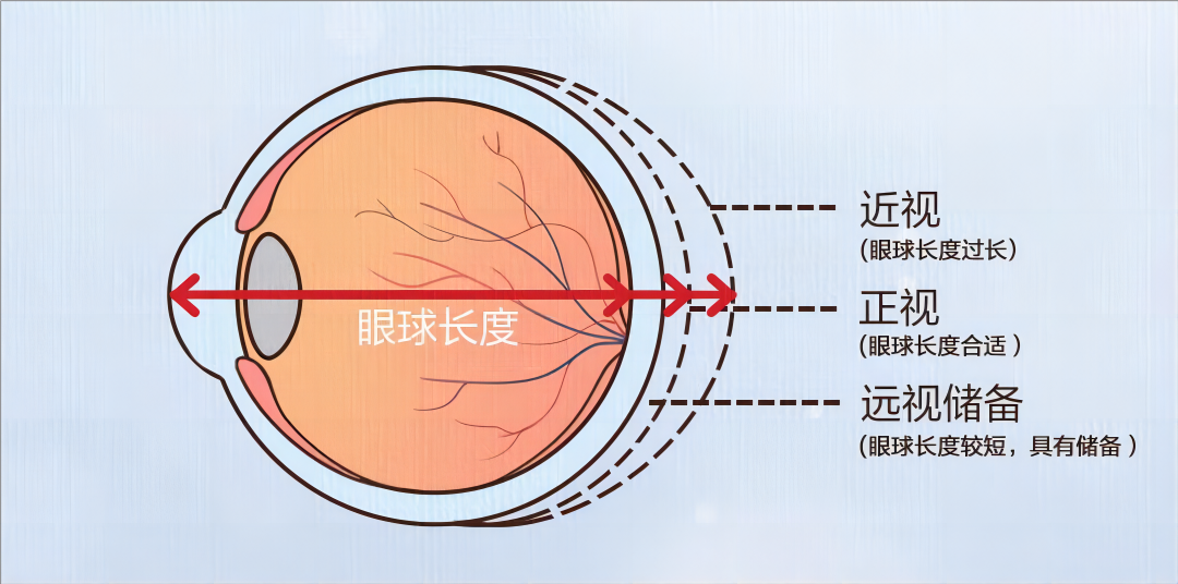 合肥愛(ài)爾眼科陳國(guó)府醫(yī)生深度揭秘：近視可逆嗎？