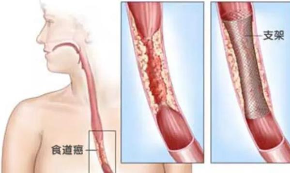 食管癌早期有哪些癥狀 食管癌后期會怎么樣