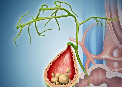 膽結(jié)石手術(shù)有風(fēng)險(xiǎn)嗎 膽結(jié)石手術(shù)有哪些風(fēng)險(xiǎn)