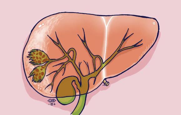 膽結(jié)石變小是好事嗎 膽結(jié)石會(huì)變小嗎