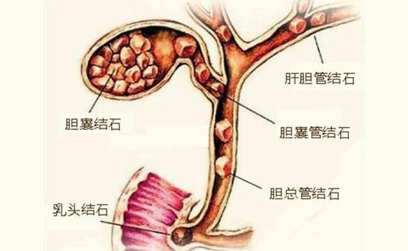 膽結石患者能吃雞肉嗎 膽結石術后能吃雞肉嗎