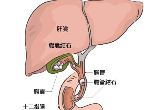 膽結(jié)石拿掉膽會怎么樣 哪些膽結(jié)石不需要手術(shù)