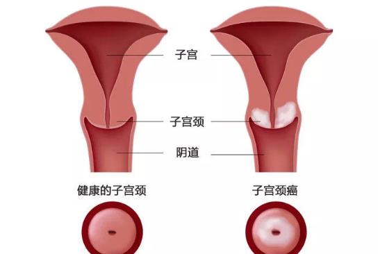 宮頸炎會不會影響月經(jīng) 輕微宮頸炎會出血嗎