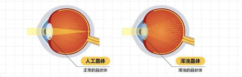 遇到這些眼睛問(wèn)題要重視！合肥愛(ài)爾專家分享—父母眼健康小知識(shí)