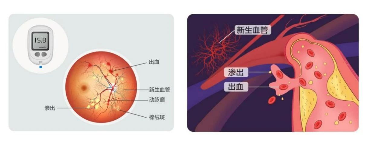 【合肥愛(ài)爾】得了糖尿病，為什么醫(yī)生讓我看眼科？