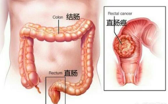 直腸癌有哪些分期 直腸癌手術(shù)分期有哪些