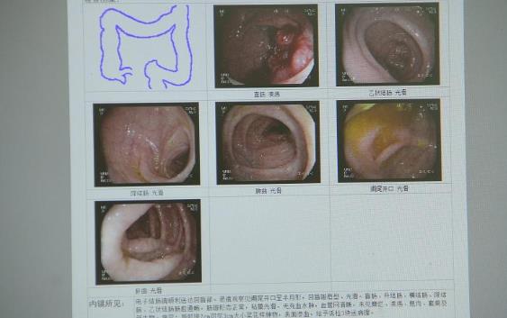 直腸癌會擴散嗎 直腸癌擴散快嗎