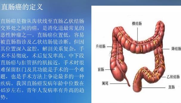 直腸癌微創(chuàng)手術(shù)怎么做 直腸癌早期手術(shù)有效嗎