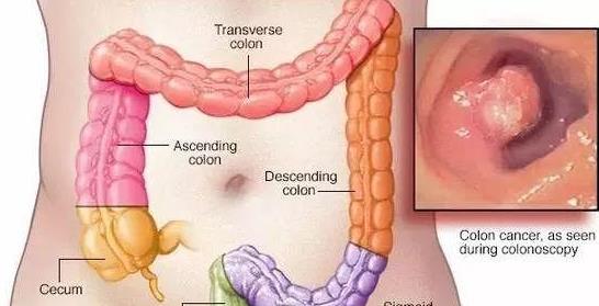 直腸癌會(huì)噴血嗎 直腸癌噴血怎么辦