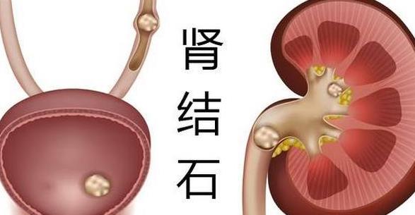 腎結石按摩有用嗎 腎結石輸液有用嗎