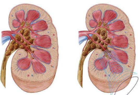 腎結(jié)石做什么運動好 腎結(jié)石不能做什么運動