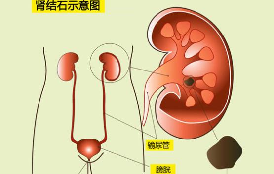 中藥能治腎結(jié)石嗎 金錢草顆粒能治腎結(jié)石嗎